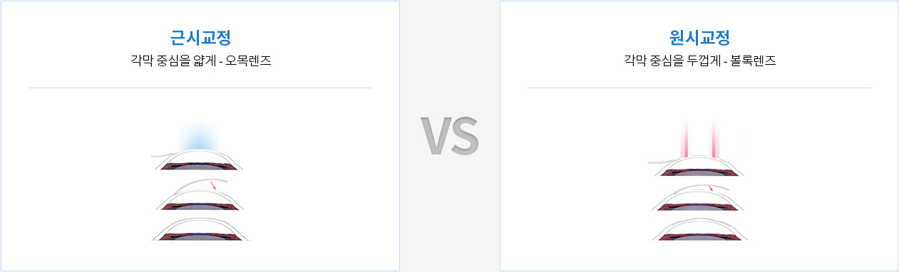 각막시력교정수술의 원리
