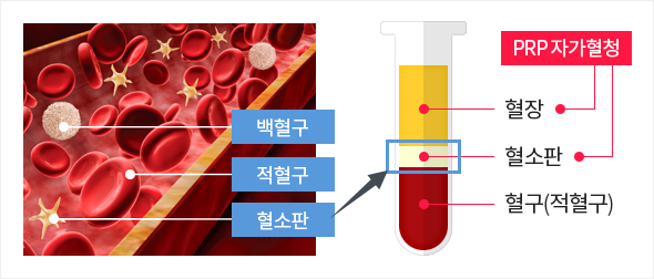 자가혈청 안약