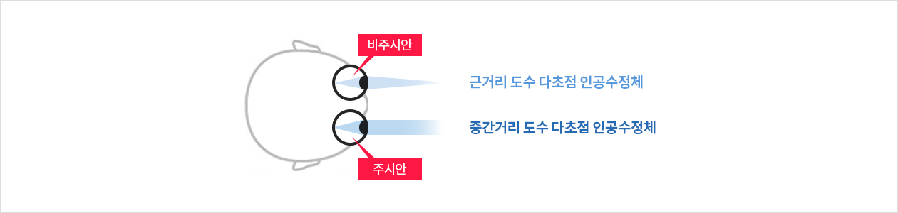 개인맞춤 노안 다초점 렌즈삽입술