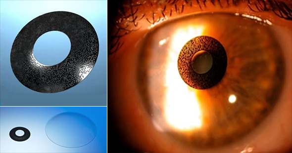 Acufocus Corneal Inlay