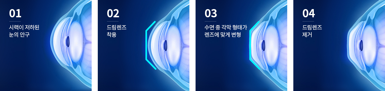 드림렌즈의 원리