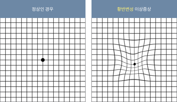 황반변성 자가 진단법