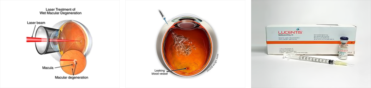 황반변성증 치료