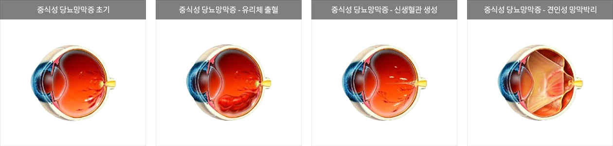 증식성 당뇨망막