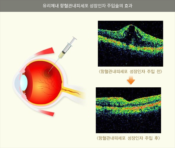 당뇨망막병증 치료