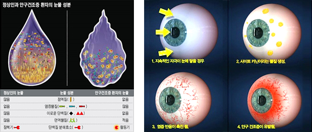 안구건조증